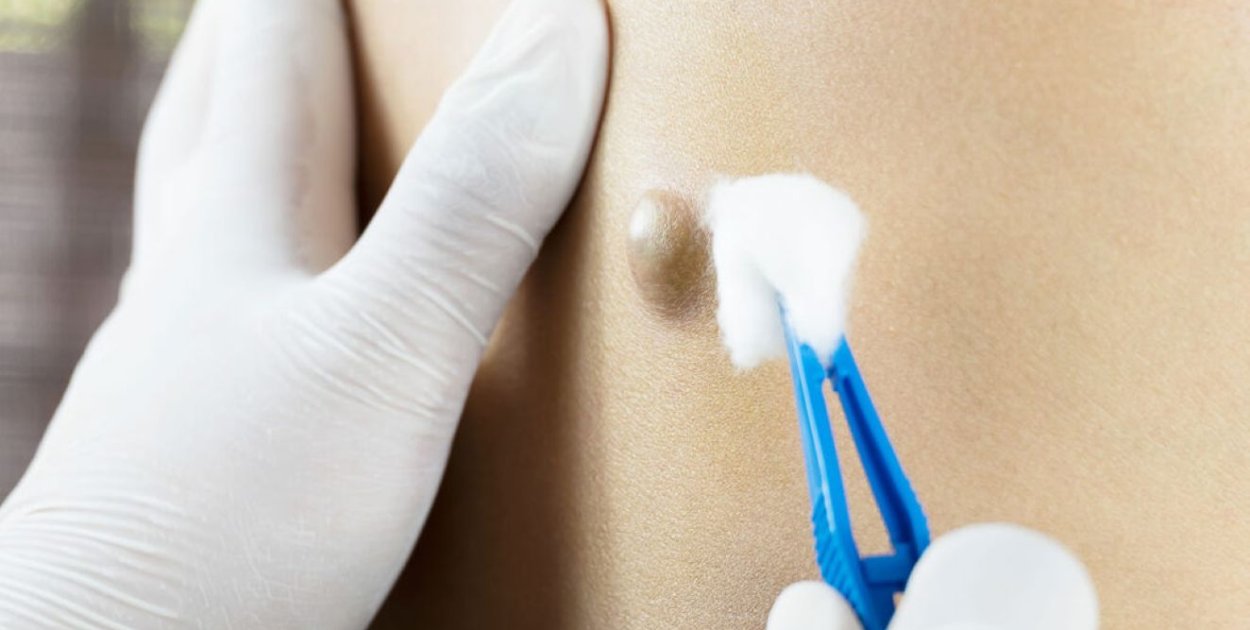 Torbiel włosowa – przyczyny powstawania i przebieg zmian zapalnych